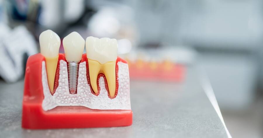 How to Find More Affordable Dental Implant Options